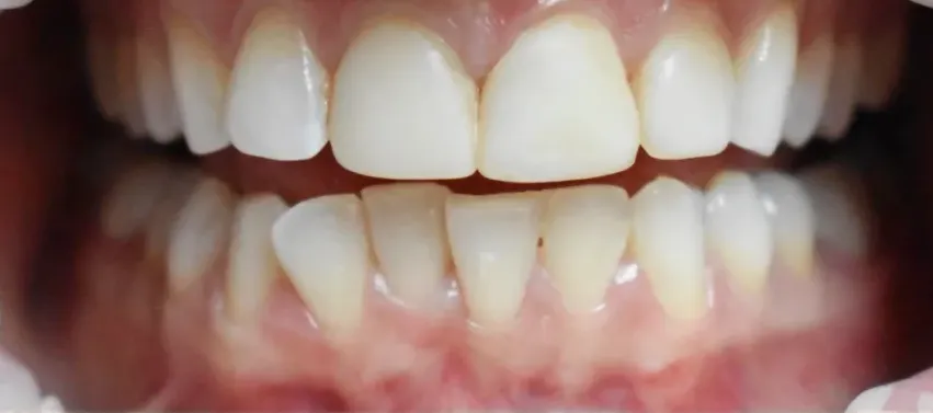 Patient smile before dental treatment